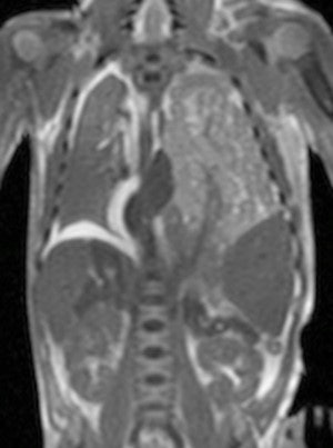 Postmortem MRI is widely used for non-neurological conditions. Coronal T2-weighted postmortem MRI of a term stillbirth with large left-sided congenital diaphragmatic hernia, containing predominantly small bowel.