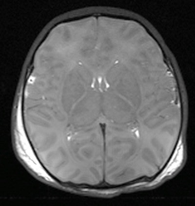 Axial T2-weighted postmortem MRI demonstrates hypoxic injury to the brain, with poor gray-white matter differentiation and cerebral edema. Differentiating antemortem from postmortem hypoxia is difficult on conventional postmortem MRI sequences.