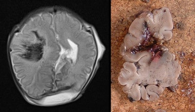 Example of intracranial hemorrhage. Axial T2-weighted postmortem MRI demonstrates right frontoparietal parenchymal hemorrhage in a 35-week gestation, fetal stillbirth (left), confirmed on histology (right). All images courtesy of Dr. Owen Arthurs.