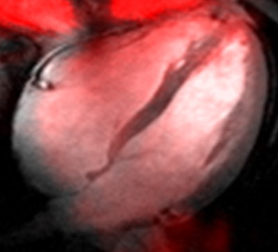 Sodium image of the human heart (in red) acquired at 7 tesla superimposed to an anatomic hydrogen MR image of a four chamber view of the heart. Image courtesy of Thoralf Niendorf, Ph.D.