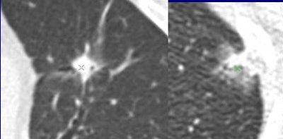Are these nodules malignant or benign? The algorithm was confident for predicting the top-row lesions (correct responses) and the first lesion (left side) in the bottom row, but not confident for the last two lesions in the bottom row (middle, right). Results are anecdotal because the outcome depends on system operating point. (Answers left to right, top row followed by bottom row: malignant, benign, malignant, benign, malignant). All images courtesy of Dr. Anthony Reeves.