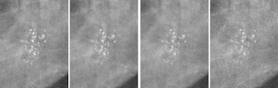 Example of an inserted calcification cluster converted to appear for the four detector types of the study at the same dose. From left to right: a-Se, CsI, CR NIP, CR PIP. All images courtesy of Dr. Alistair Mackenzie.