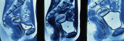 Sequence of MR images showing filling of the bladder during coitus.