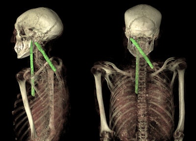 Image shows use of sticks to reassemble the head with the body during mummification.