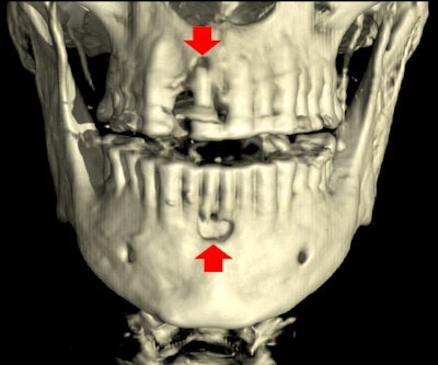 Image shows location of possible dental abscesses.