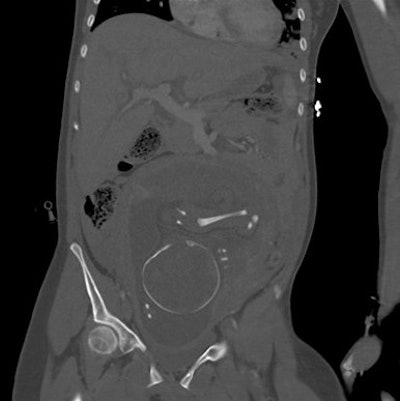A patient in her third trimester (29 weeks). Examined for polytrauma.