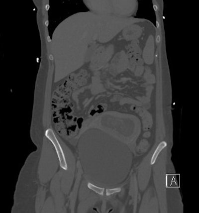 Unknown pregnancy; patient examined within the first 12 weeks for polytrauma.