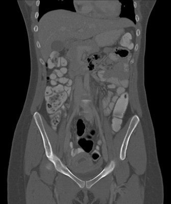 CT exam of a patient with Crohn's disease, pregnant for six weeks and previously unknown. All images courtesy of Dr. Federica Zanca.
