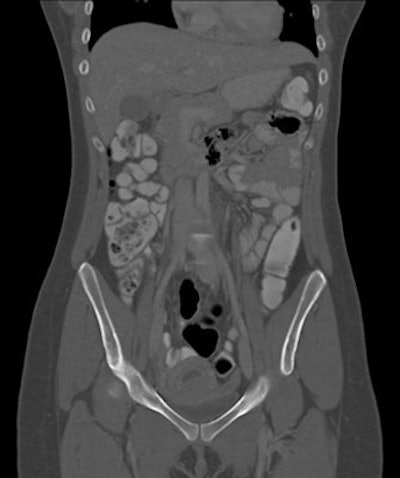CT exam of a patient with Crohn's disease, pregnant for six weeks and previously unknown. All images courtesy of Dr. Federica Zanca.