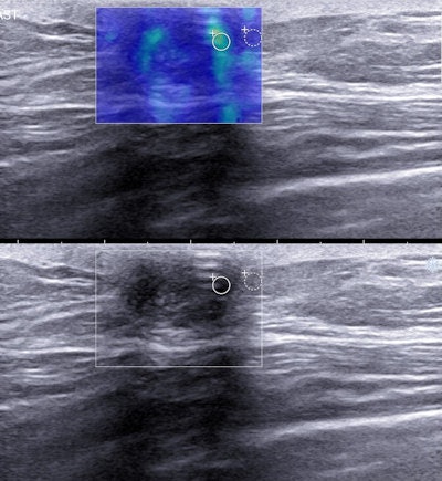 Elastography images of triple-negative breast cancers. They often demonstrate benign elastographic features, such as they are less stiff and have lower lesion-to-fat stiffness ratio than other invasive breast cancers. Image courtesy of Dr. Martina Džoić Dominković.