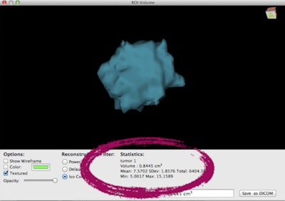 3D reconstructions of Mammi PET breast images acquired in March (top) and April (bottom) during neoadjuvant chemotherapy show sharp reduction in tumor volume, from 0.8445 cm3 to 0.1705 cm3.