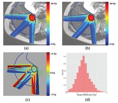 Comparison of a liver tumor treatment plan generated without a magnetic field (top left) and a plan generated with a 1.5-tesla field (top right). A plot and histogram (bottom row) of the dose difference between the two shows equivalent target coverage, as for the other two cases.