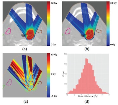 Comparison of treatment plans for a deep head-and-neck tumor, generated without a magnetic field (top left) and with a 1.5-tesla field (top right). A plot and histogram (bottom row) of the dose difference between the two shows equivalent target coverage, but bigger differences than for the shallow tumor.