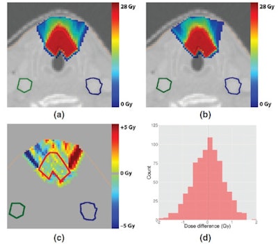 The head-and-neck tumor treatment plan generated without a magnetic field (top left) was compared with the plan generated with a 1.5-tesla field (top right). A plot and histogram (bottom row) of the dose difference between the two shows equivalent target coverage. All images courtesy of Joris Hartman.