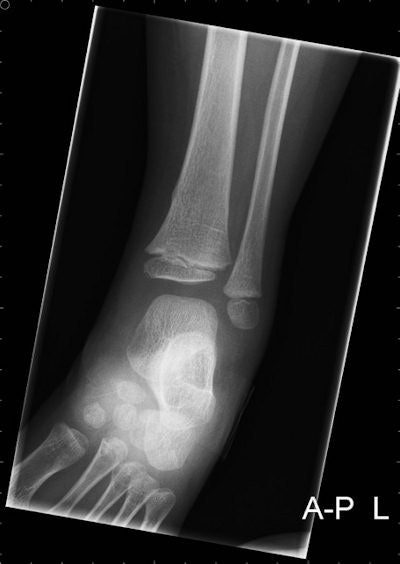 Radiographs of a 4-year-old boy with bicycle spoke wheel injury. Images courtesy of Annelie Slaar.