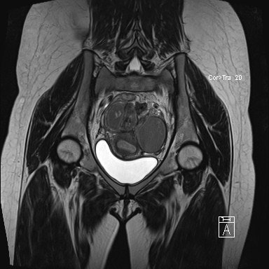 Coronal T2- and T1 fat-saturated imaging demonstrates bilateral ovarian endometriomas