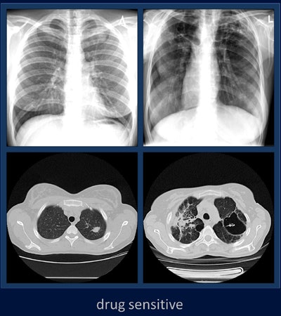 Two drug-sensitive cases (above) and two drug-resistant cases (below). Each column shows one x-ray image and one CT slice. Images courtesy of Vasiliy Kovalev.