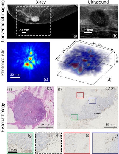 PA images showing a ring-like lesion (middle) are compared with conventional clinical images (top) and H&E and CD-31 stained tissue sections (bottom) showing tumor cell and vascular endothelial cells. Credit: Scientific Reports.