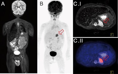 Whole-body FDG-PET/MRI exam of a 1-year-old girl with metastatic teratoma. Combined PET/MRI enables simultaneous acquisition of whole-body MRI (A) and PET (B) as well as local MRI (C.I). MRI shows a paravertebral metastasis (C.I, red arrow), which is metabolically active on FDG-PET (C.II, PET/MRI fusion image).