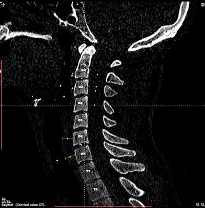 Sagittal cervical spine CT image with anatomic landmarks on Imaging Anatomy. Image courtesy of Dr. Jens Borgbjerg.