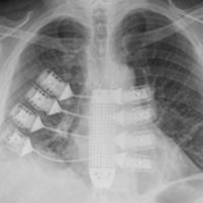 Customized 3D-printed titanium ribs implanted in patient | AuntMinnieEurope