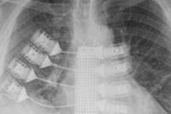 2015 09 18 11 10 38 477 2015 09 21 Titanium Xray Bottom 20150921160829
