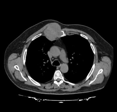 Above, preoperative CT scan before implantation of titanium prosthesis. Below, postoperative chest radiograph shows good placement of the device. CT was not repeated postoperatively due to the patient's good condition, and the potential for metal artifact with CT. Images courtesy of Dr. Jose Aranda, PhD.