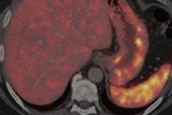 2015 09 22 09 17 07 542 2014 02 20 17 31 07 273 Pet Ct Net Haug Rad 450 20150922161746
