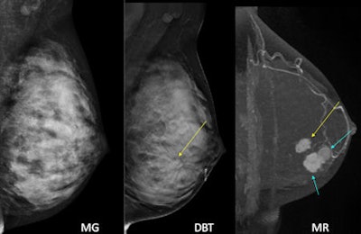 A patient with multifocal invasive ductal carcinoma. On mammography (MG) nothing can be seen. But on DBT, the mass with architectural distortion can be seen clearly. However, it was not enough; there were even larger masses in the same breast in this patient, obscured by breast density on DBT. The other masses were hard to find even in retrospect. The final pathology revealed total 4 cm extent of invasive ductal carcinoma with combined ductal carcinoma in situ. All images courtesy of Dr. Jung Min Chang, PhD.