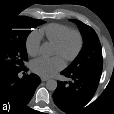 Two examples where the system disagreed with reference annotations. Above) A motion artifact in the RCA that the system detected as a coronary calcification. Below) A coronary calcification in the distal RCA that was not identified by the system. All images courtesy of Dr. Jelmer Wolterink.