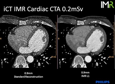 If you have it, iterative reconstruction can be an effective way to reduce dose. This 0.2-mSv cardiac CT angiography examination demonstrates standard reconstruction versus iterative model reconstruction (IMR). Image courtesy of Philips Healthcare.