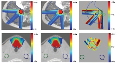 Proton therapy plans for liver (top row) and larynx (bottom row) treatments, generated without (left) and with (center) a 1.5-tesla field; the dose difference is shown on the right.(from Phys. Med. Biol. Vol. 60:15, pp. 5955).