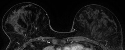 MR images of early detected invasive ductal carcinoma (grade II, 5 mm, SN 0/2).