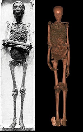 CT showed King Tut had a mild form of club foot compounded by avascular necrosis. All images courtesy of Dr. Ashraf Selim.