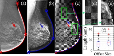 Demonstration of the registration algorithm for matching the breast contour lines (red/blue lines) from DBT (a) and 2D mammography (b) scans. After matching the breast contours, the internal tissue anatomy shows good alignment in the checker-box overlay (c) of the two images. For all 67 lesion cases, the mean tumor offset generated from the registration was 12.7 ± 0.9 mm, as shown in the box plot in (f). Image credit: Characterizing breast lesions through robust multimodal data fusion using independent diffuse optical and x-ray breast imaging, 2015 Bin Deng et al J. Biomed. Opt.
