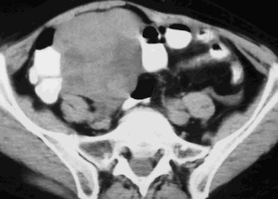 Undifferentiated ovarian carcinoma in a 59-year-old woman who is a carrier of the BRCA2 mutation. CT demonstrates a large, multilobulated complex cystic-solid right adnexal mass. There were neither ascites nor enlarged lymph nodes.
