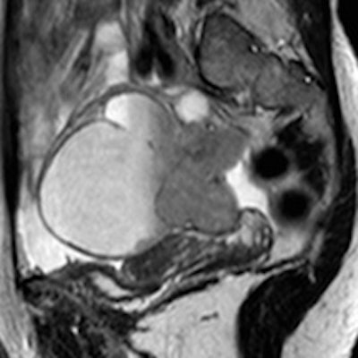 MR image of a high-grade ovarian serous carcinoma in a BRCA1 mutation carrier