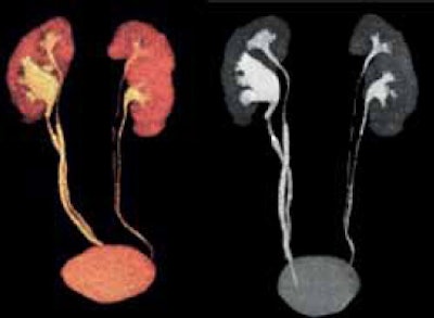 Sequential image acquisition (five volumes) of a 62-year-old woman. Body mass index: 33.8 -- uro CT: bilateral pyeloureteral duplicity with lithiasis within the lumbar ureter of the lower right pyelon with overlying spasms. Volume rendering and maximum intensity projection reconstruction -- continuity of the different segments of the ureter are satisfactory -- dose length product 149 mGy.cm.