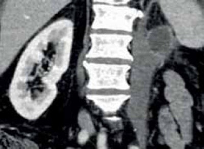 Monochrome image at 50 kV, coronal slice, arterial phase, contrast product used: 270 mgI/ml-50cc or 13.5 gr of iodine. All images courtesy of JFR.