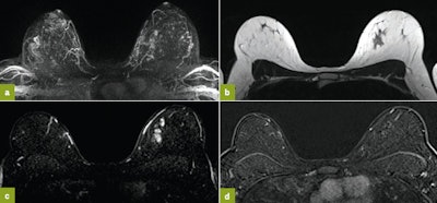 2015 10 21 09 36 38 518 2015 10 21 Jfr Breast Image1