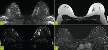 2015 10 21 09 36 38 524 2015 10 21 Jfr Breast Image1 350