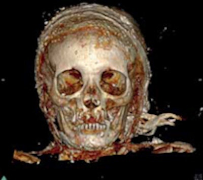 A 3D reconstruction with volume rendering of the head, frontal view. All images courtesy of JFR.