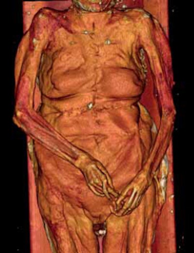 A 3D reconstruction with volume rendering of the thorax, abdomen, and pelvis, frontal view.