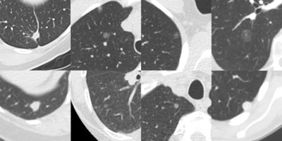 Eight randomly chosen examples of false negatives of Herakles. Each image shows a transverse field-of-view of 60 x 60 mm in which the nodule is centered. Many missed nodules are subsolid.