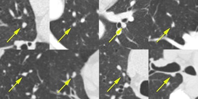 Examples of nodules that were missed by LIDC annotators. These eight randomly chosen examples of solid nodule annotations were marked as nodules 3 mm or larger by all four new readers in the observer experiment. These nodules were not annotated by any of the original LIDC readers. Each image shows a transverse field-of-view of 60 x 60 mm in which the nodule is centered. Next to the fact that the extra nodules were hard to detect, another reason why the LIDC readers missed these nodules may be that they only inspected transverse sections. All figures courtesy of Colin Jacobs.