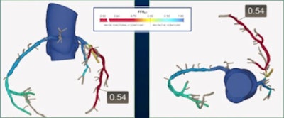 FFRCT shows a hemodynamically significant lesion in the left anterior descending (LAD) artery. Images courtesy of lead author and ESC presenter Dr. Pamela Douglas.