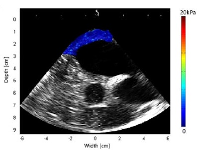 Shear modulus maps of a right atrium (above) and right ventricle free wall (below) superimposed on B-mode images. The mean shear modulus within the atrial wall, acquired at atrial systole, was 1.3 ± 0.3 kPa; the mean shear modulus in the right ventricle, acquired at ventricular diastole, was 1.7 ± 0.5 kPa.