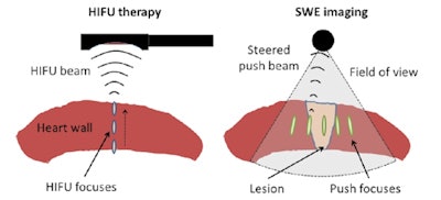 Schematic representation of the in vitro therapy-imaging configuration. Left: HIFU is performed through the entire wall depth using the electronic steering along the central axis of the probe. Right: SWE imaging is realized before and after ablation. Five to seven laterally steered pushes (focusing using the imaging probe) are performed to cover the whole field-of-view with shear-waves. All images courtesy of Wojciech Kwiecinski.