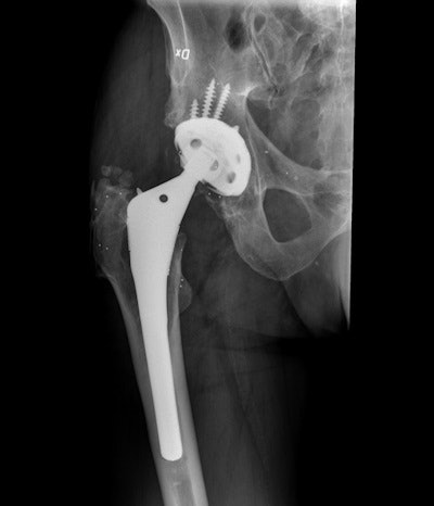High resolution x-ray shows prosthetic hip implant. The white dots are the tantalum markers that will create polygons between bone and implant. All images courtesy of Dr. Maziar Mohaddes, PhD.