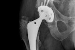 2015 10 27 10 44 27 789 2015 10 28 Hip Rsa Marker 20151027175707